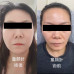4D童顏針 #童顏針讓你悄悄變美的秘密武器！